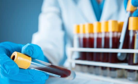 Researcher analyzing tubes of blood with yellow caps, used to explain COVID-19 and blood types