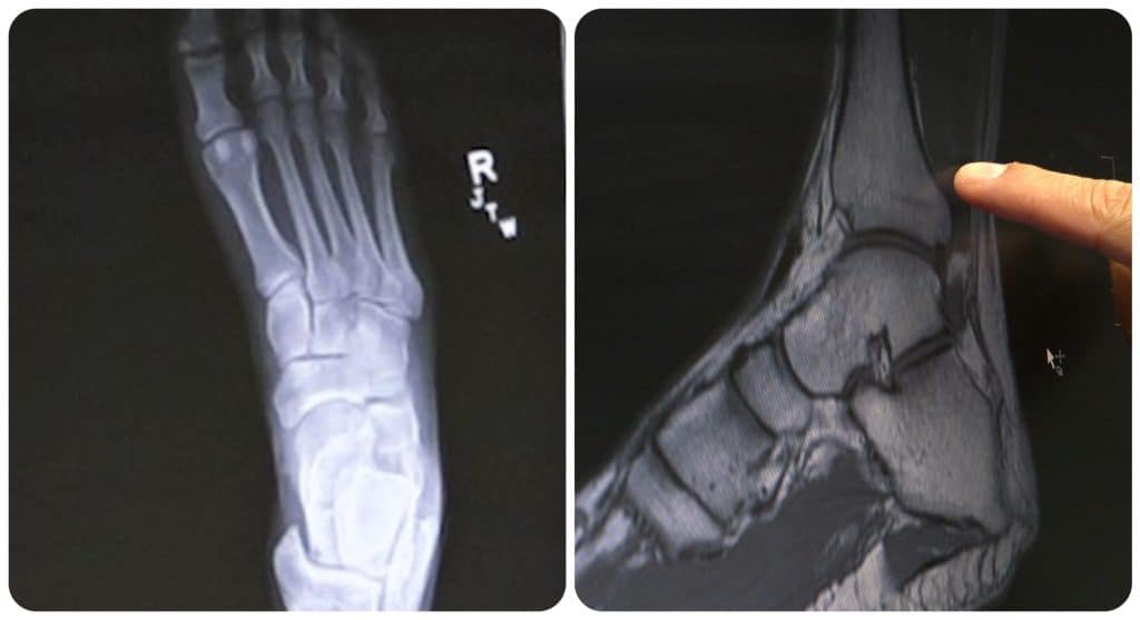 X-rays of DeSoto Fire Capt. Craig Kirk's foot