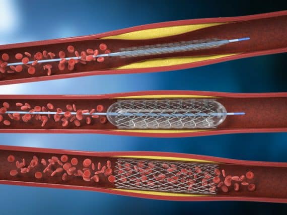 How a heart attack can strike 'out of the blue' | Shine Online | Your ...
