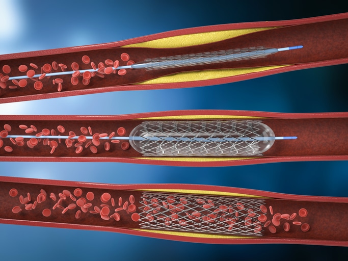 Medical graphic representing procedures to open up arteries if someone is suffering a heart attack