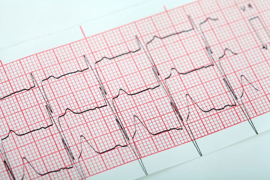 Electrocardiogram