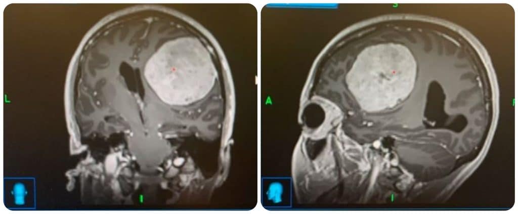 Brain scans which show a tumor