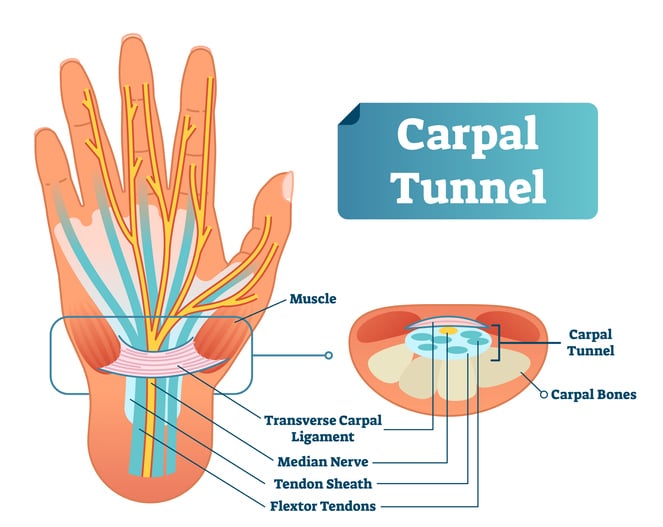 Explanation and anatomical display of carpal tunnel syndrome