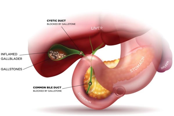 Medically accurate representation of gallstones, inflamed gallbladder and the systems surrounding it