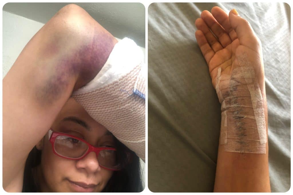 Leslie Armijo Cannon's injuries after her car crash, including a photograph of a bruised elbow and her shattered wrist