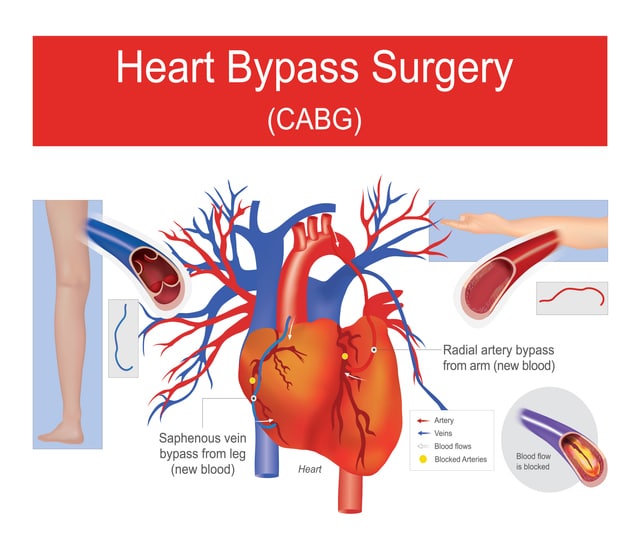 Medical explanation graphic of a heart bypass surgery
