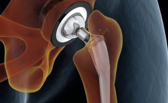Anatomical representation of a hip replacement