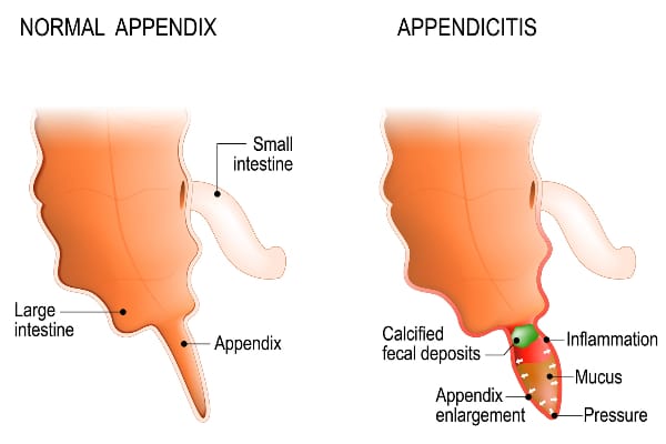 An educational diagram comparing a normal appendix and one with appendicitis