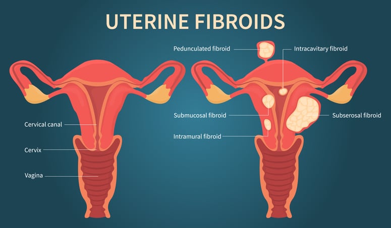 A medical educational diagram explaining uterine fibroids with each of the parts of the anatomy identified