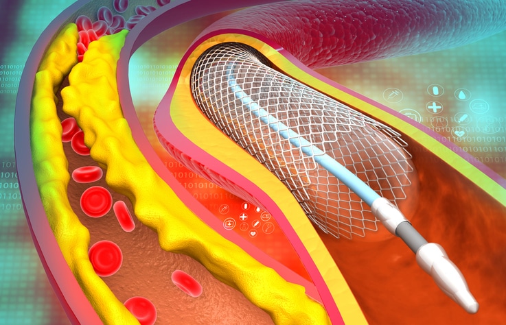 An educational graphic of how placing a stent works