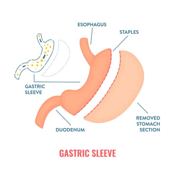 Diagram of gastric sleeve with labels for duodenum, removed stomach section, staples, esophagus, gastric sleeve