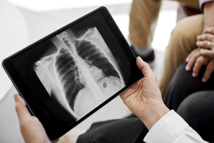 A medical provider's arms holding an X-ray of the chest
