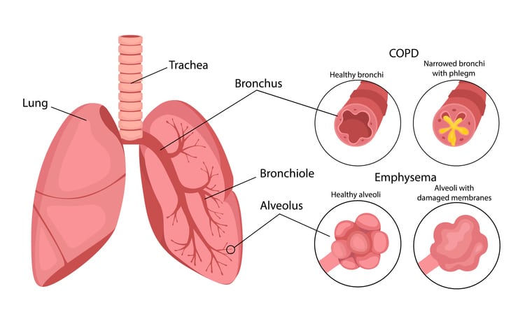 A medical diagram graphic of the lungs with identifiers for the lung, trachea, bronchus, bronchiole, and alveolus, with side diagrams for COPD and emphysema explanations