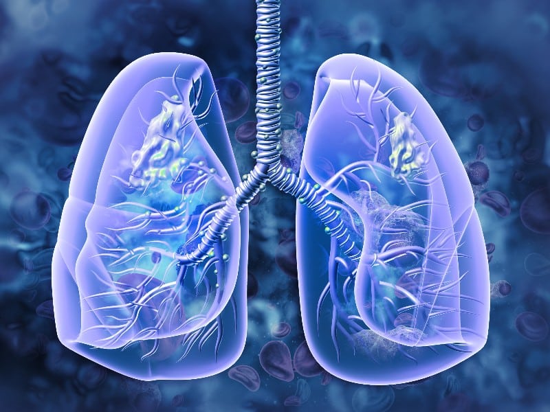 A medical diagram designed with bright purple and blue, used to explain emphysema