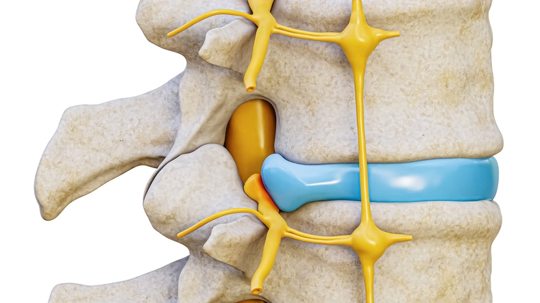 A medical diagram of the gel-like cushions between the vertebrae in human spines