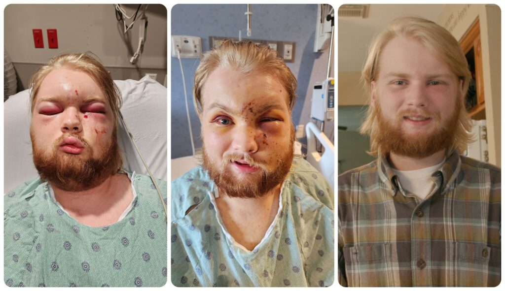 Shawn Adams photographed after his snake bite and during the recovery