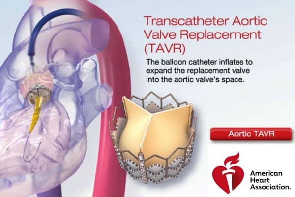 Graphic from the American Heart Association explaining the TAVR procedure