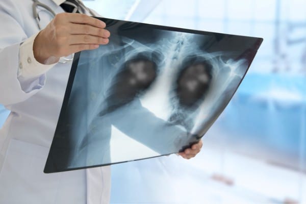 Medical provider in a white coat looking at an X-ray or scan results, which shows masses in the lungs