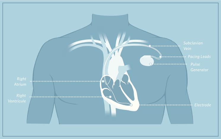 Cartoon educational drawing and model of how a pacemaker works