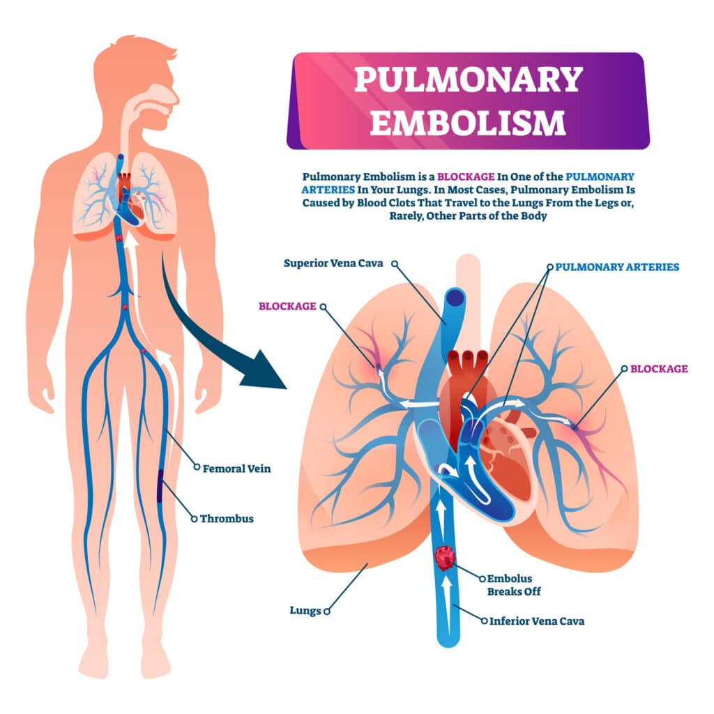 An educational graphic used to explain "pulmonary embolism" and how it looks in the body