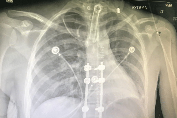 An X-ray image of a chest with titanium rods and screws