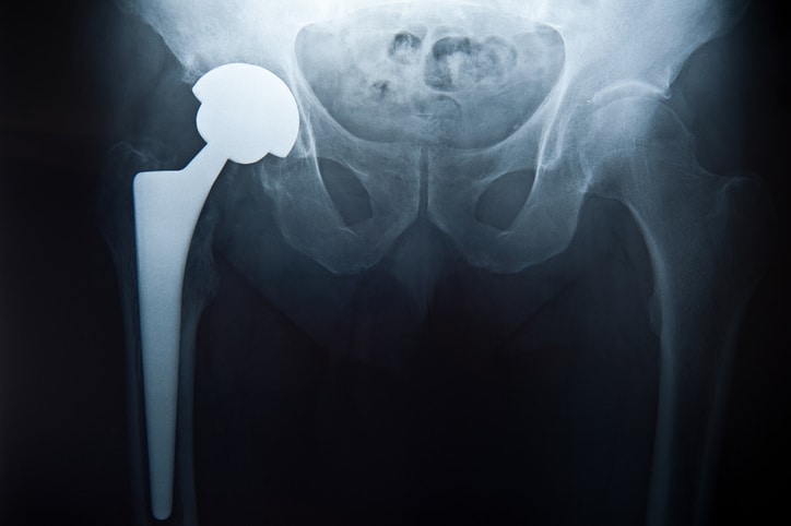 An X-ray image depicts a the result of a hip replacement surgery, with the new hip on the left side of the image.