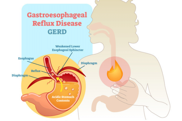 An educational poster that explains GERD and shows the internal structures of the body when someone has GERD