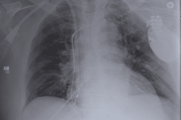 A CT image of the chest