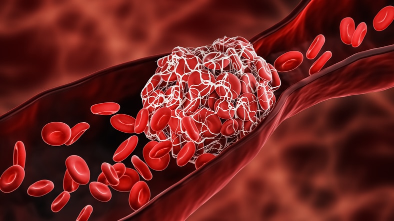 A stock educational graphic used to show a blood clot