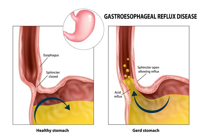 A educational diagram that explains gastroesophageal reflux disease