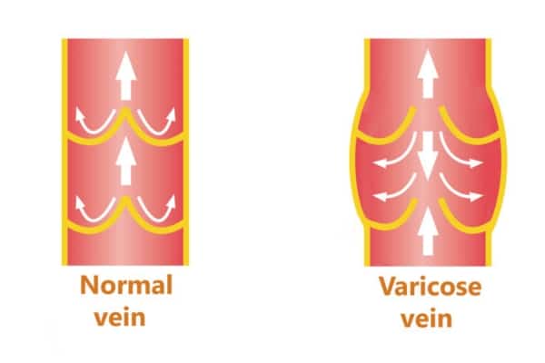 On the left, a picture of a vein showing blood flow in one direction is captioned "Normal vein." On the right, a picture of a vein with pooled blood is captioned "Varicose vein."