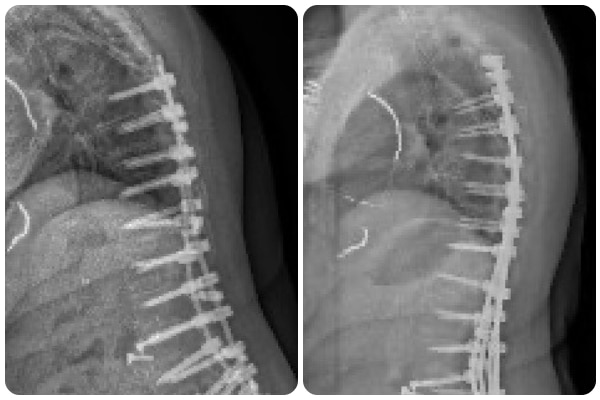 On left, an X-ray image shows a bent spine. On right, an X-ray image shows a straighter spine.