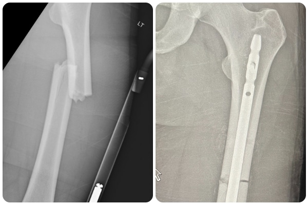 On the left, an X-ray image depicts a broken femur. On the right, an X-ray shows the femur in place, stabilized by a rod.