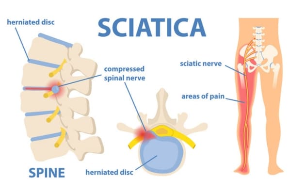 An educational graphic with the text "SCIATICA" at the top with two educational renderings of a spine with a herniated disc and a leg with the sciatic nerve highlighed