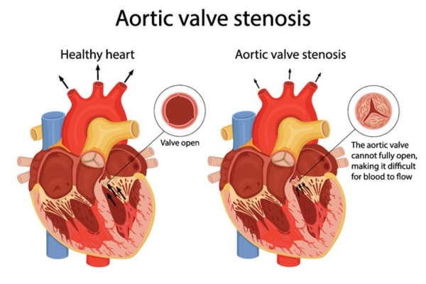 An educational graphic of aortic valve stenosis