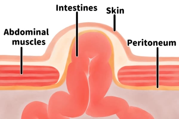 An educational graphic explaining how a hernia occurs, with text labeling the abdominal muscles, intestines, skin, and peritoneum