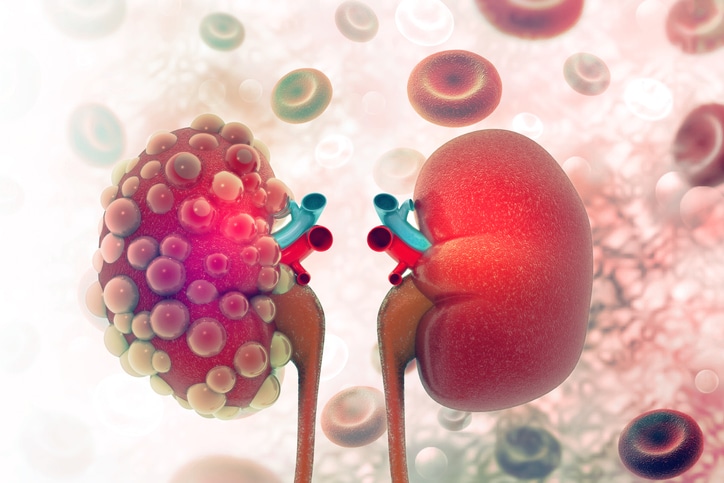 In this rendering of the kidneys, one is shown covered with small globules. Behind the kidneys, larger-than-life red blood cells float against a glowing background.