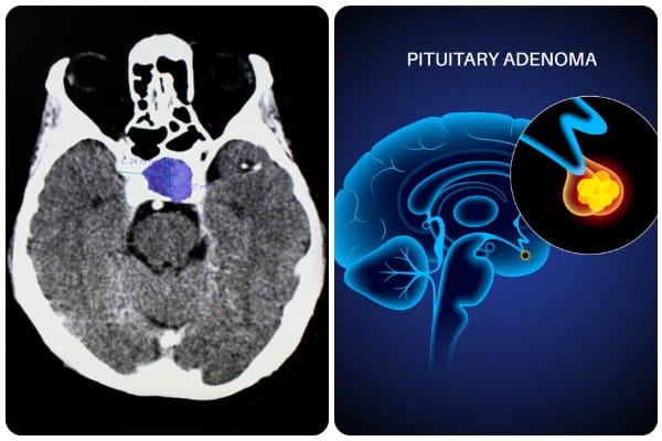 The left side of this image shows a scan of the brain with a section near the front highlighted in blue. The right side is a CGI of a brain with a detail shown in orange. It is labeled "Pituitary Adenoma."