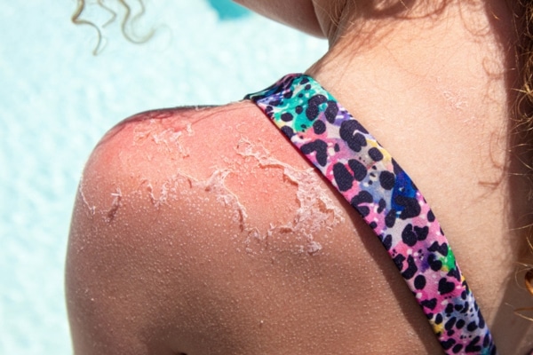 A close-up image of a shoulder with peeling sunburn