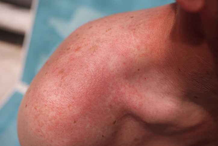 A close-up image of a shoulder with freckles