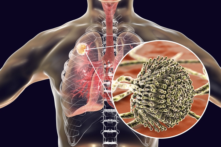 In this computer-generated image of a torso and lungs, a closeup view depicts a mass in the upper section of one lung.