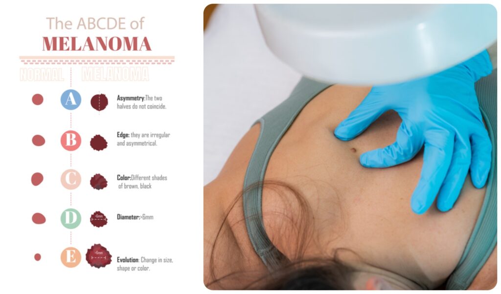 On the left, a chart displays the ABCs of melanoma: asymmetry, edge, color, diameter and evolution. On the right, a woman lies face-down in a medical setting. A hand wearing a blue glove pinches up skin around a mole on her back.