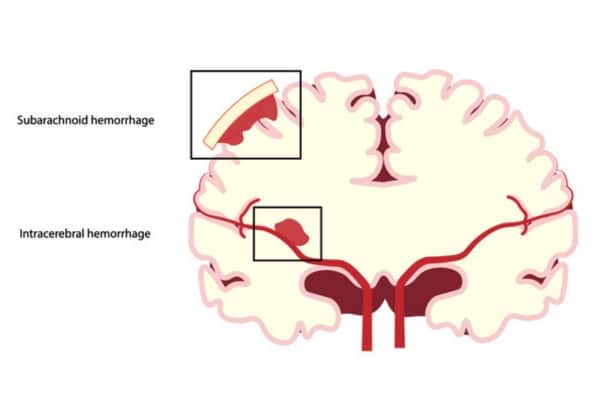 A diagram of the brain illustrates a subarachnoid hemorrhage and an intracerebral hemorrhage.