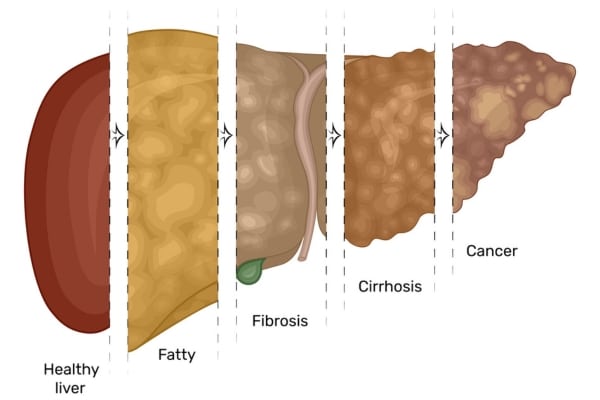 Fatty liver disease can progress to hepatitis, cirrhosis, and even cancer.