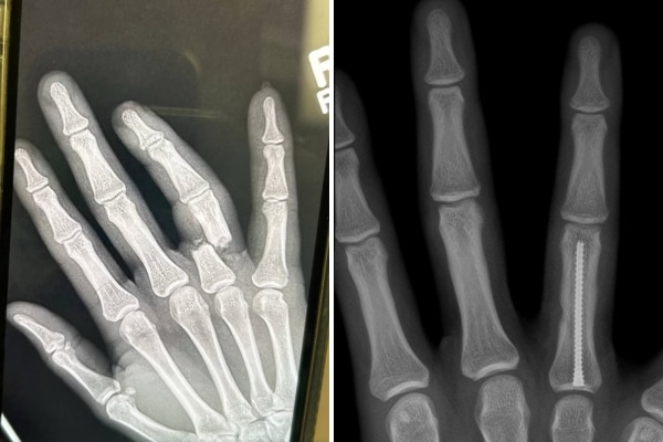 X-rays show Kade's hand after the injury and after surgery, when a titanium screw was inserted into his finger.