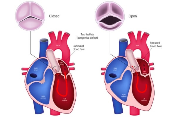 Graphic shows a bicuspid aortic valve, a heart defect where the valve only has two leaflets rather than three.