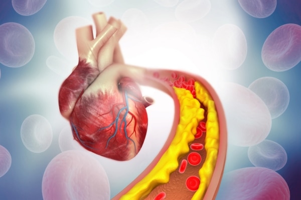 A diagram shows plaque buildup in a coronary artery.