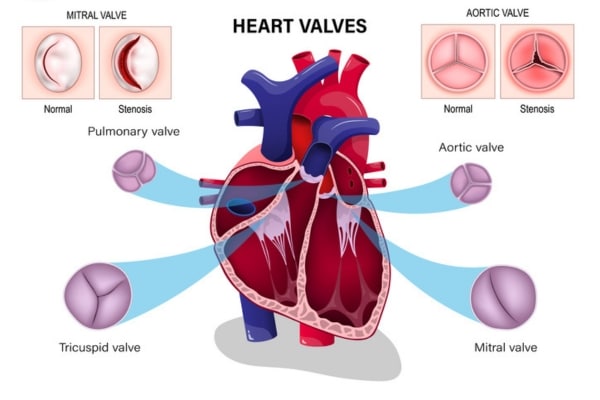 A diagram shows the various valves in the human heart and how stenosis can compromise them.