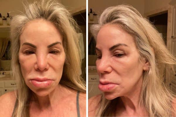 Michelle is featured in a two photo, side-by-side collage, where her face is completely swollen from a lupus flare up.