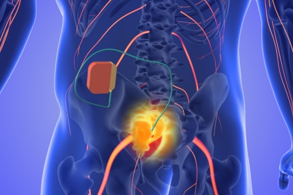 A graphic shows a bladder pacemaker implanted in a patient with overactive bladder.